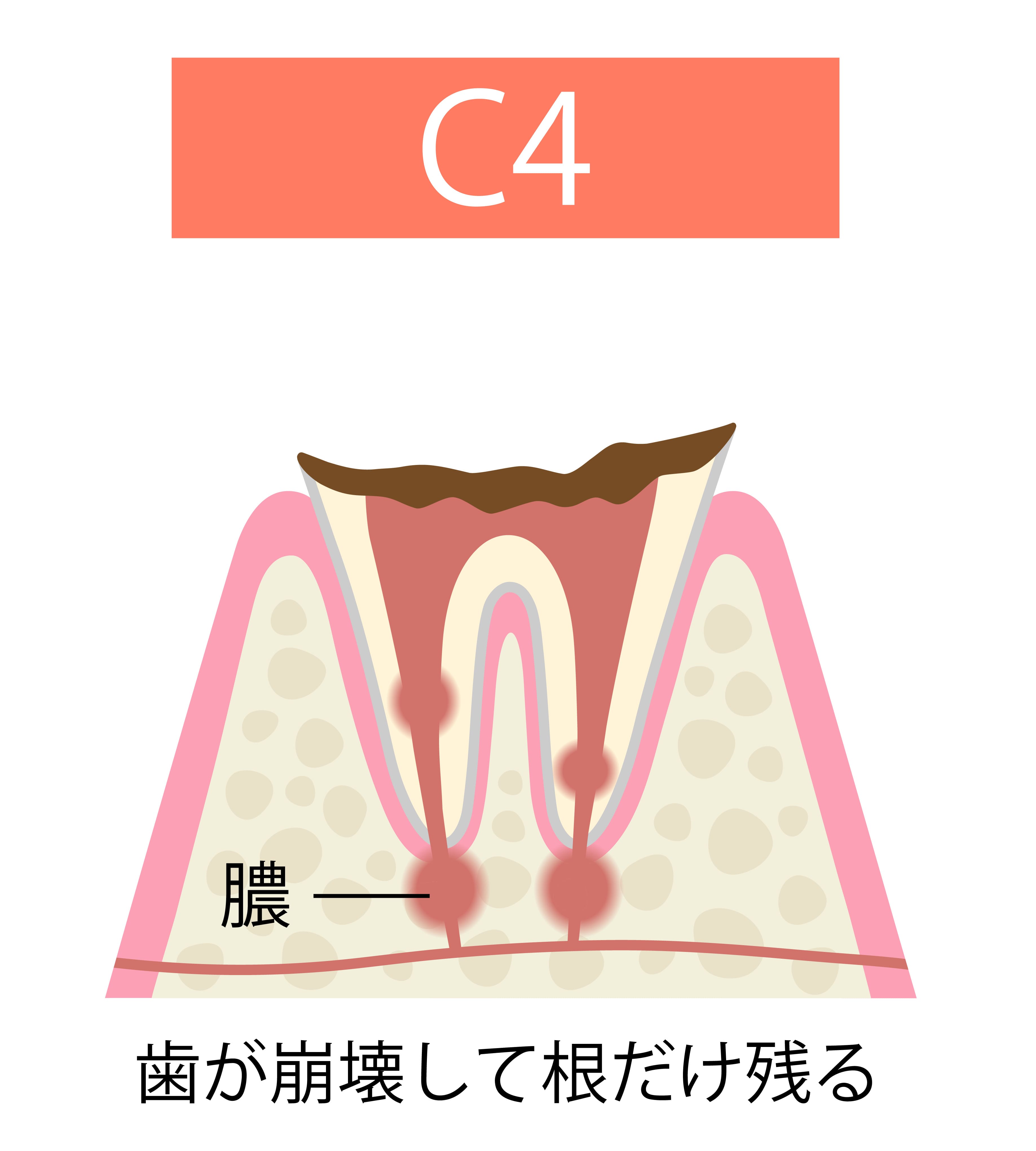 caries