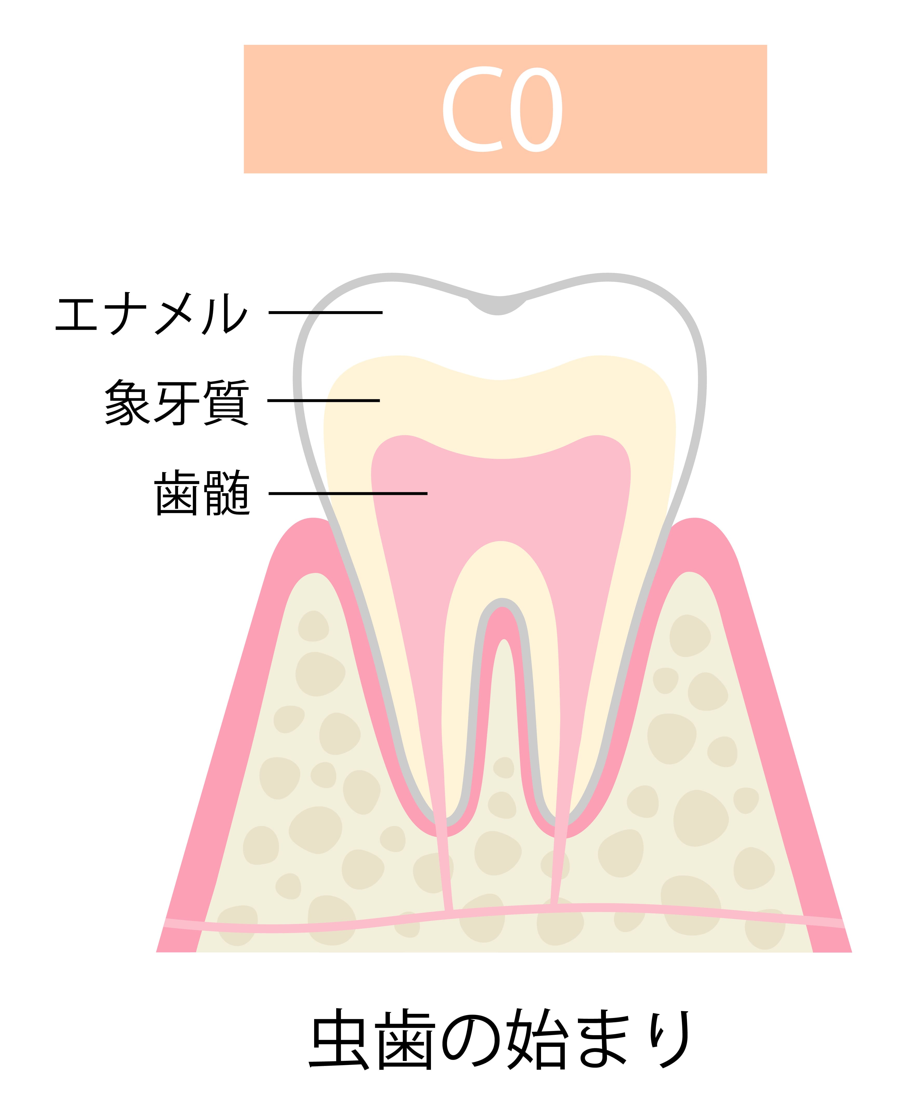 caries