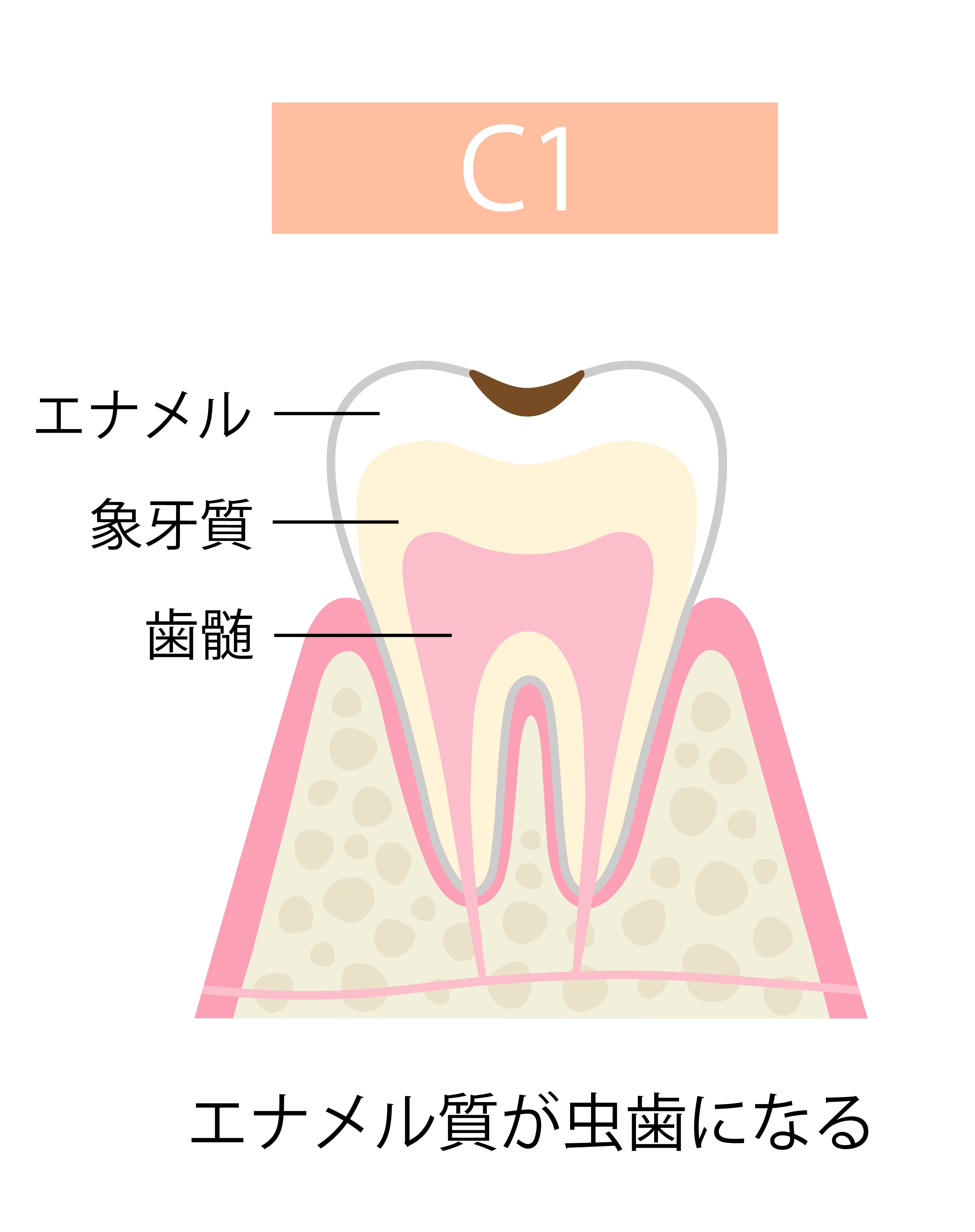 caries