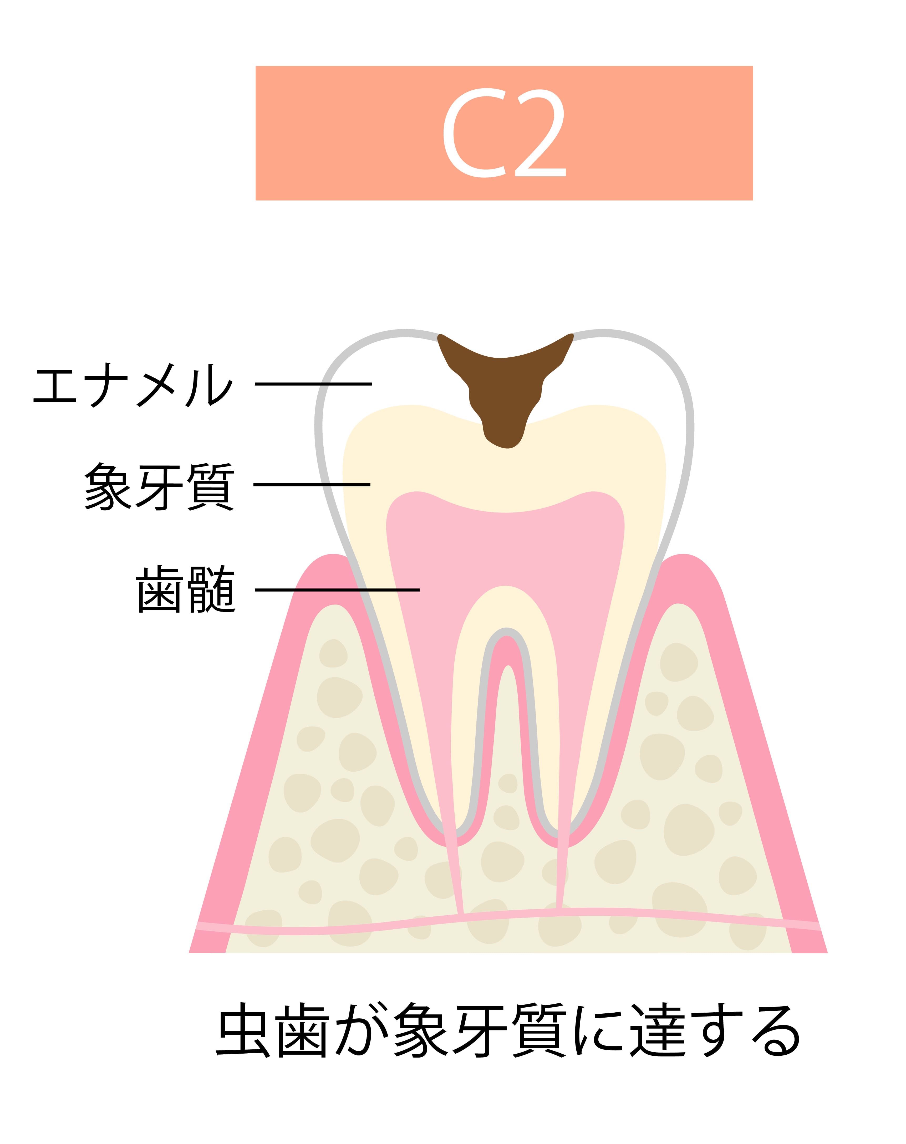 caries
