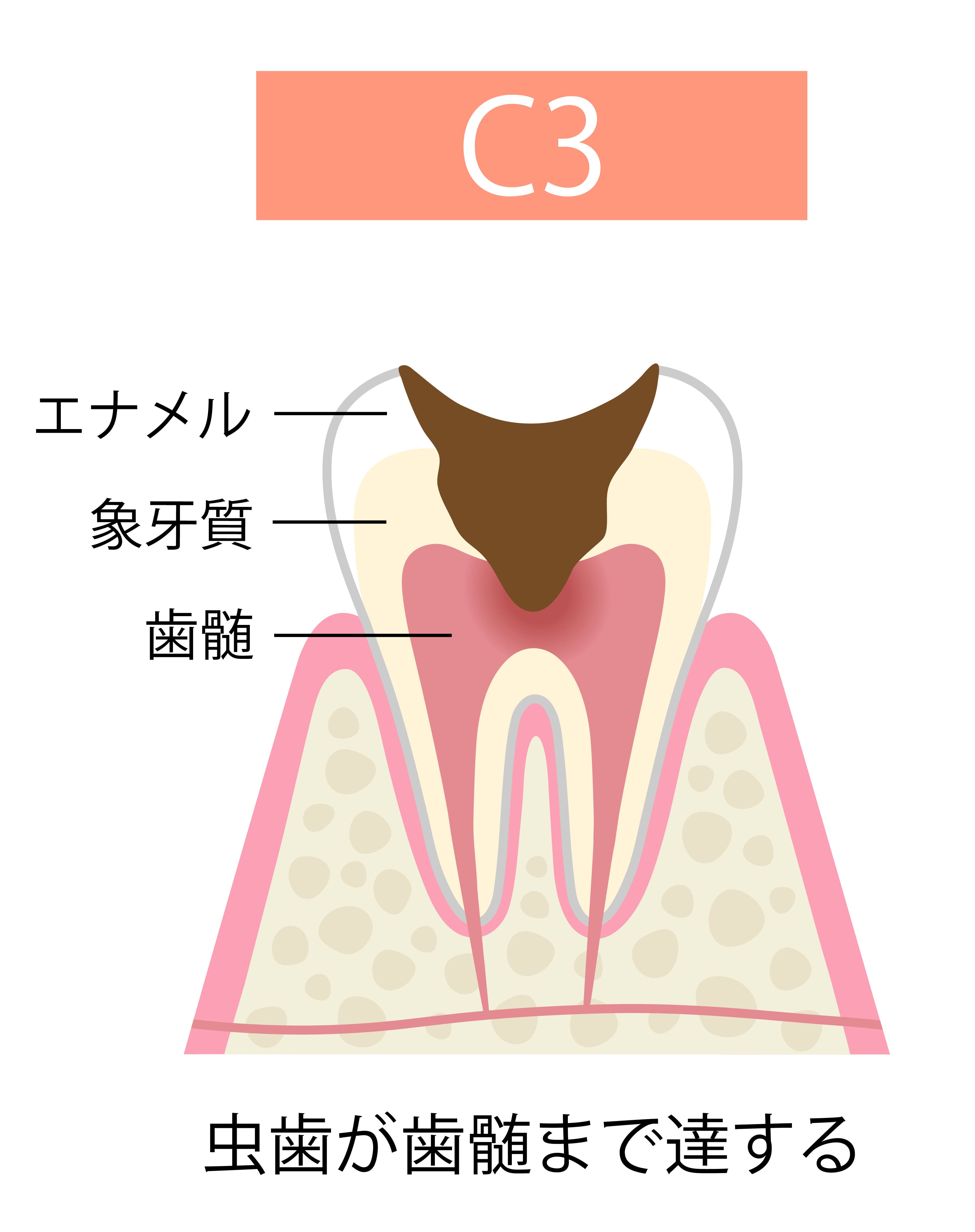 caries
